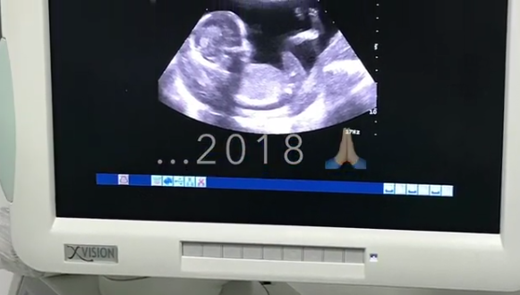 Adriana Sant'Anna Rodrigão mostram ultrassom do segundo filho