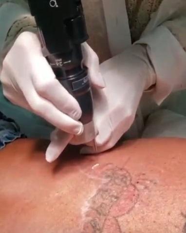 Gretchen removendo tattoo